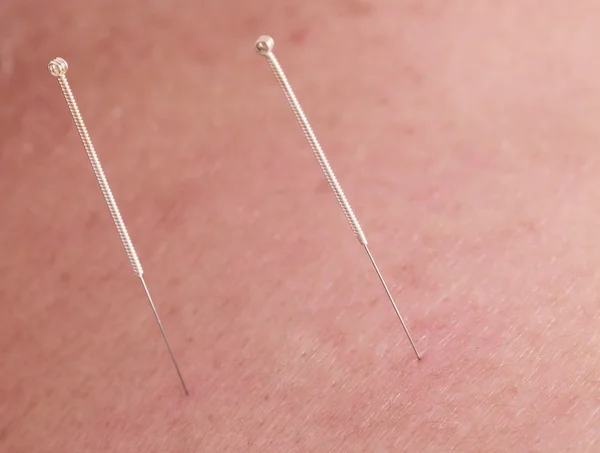 stock image Acupuncture needles