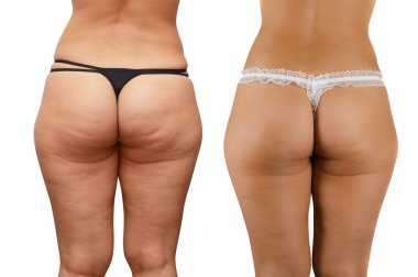 Cellulite buttocks clipart