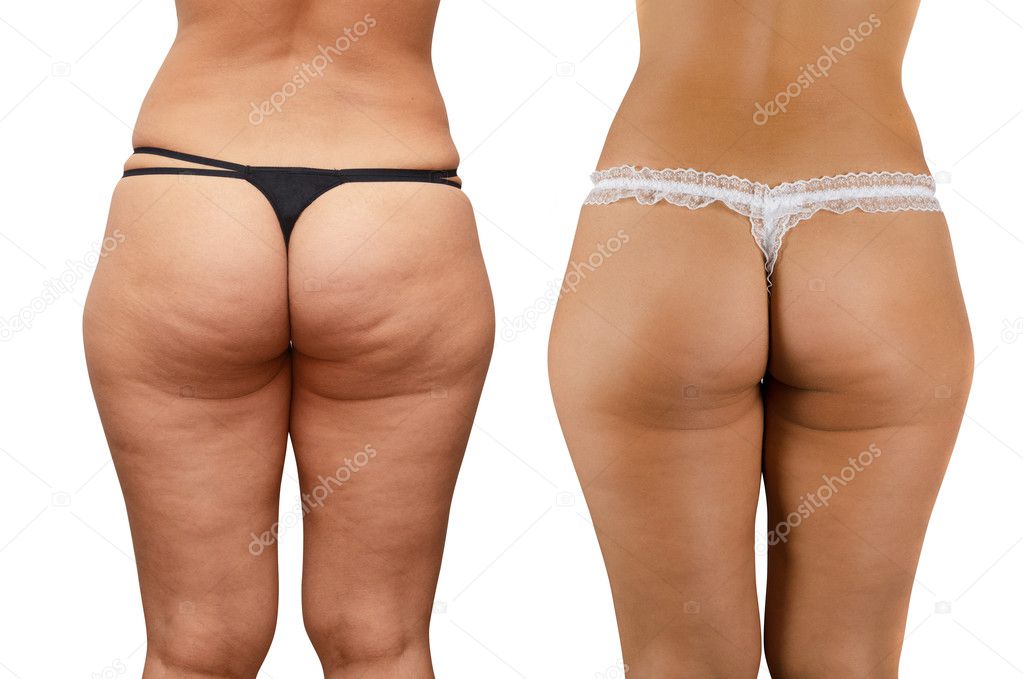 Cellulite buttocks