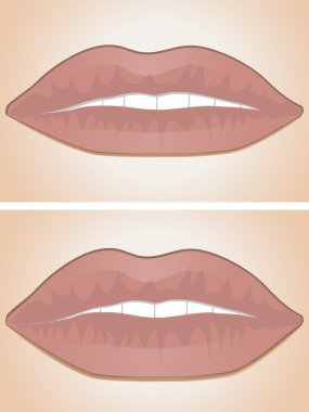 dudak dolgu öncesi ve sonrası