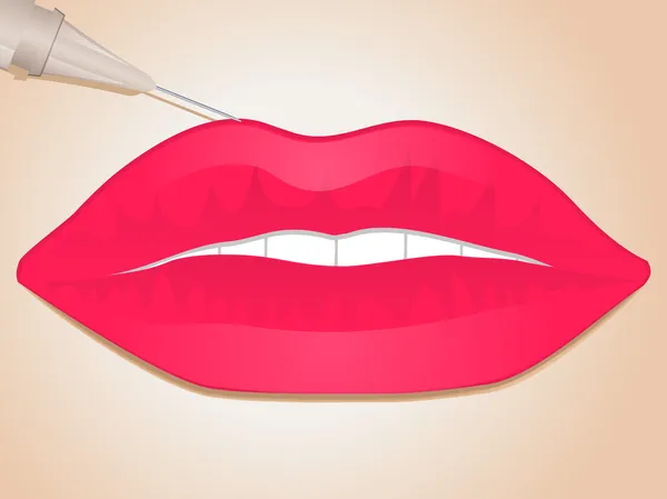 Injection de remplisseur de lèvres — Image vectorielle