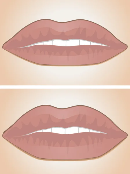 Lip filler before and after — Stock Vector