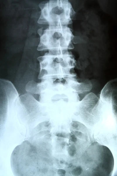 X-ray of the pelvis and spinal column. — Stock Photo, Image