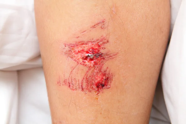 Wound on leg — Stock Photo, Image
