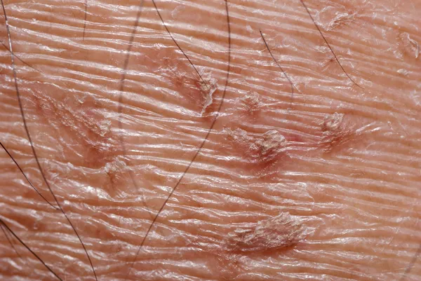Texture peau sèche — Photo