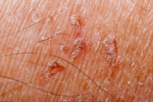 Textura seca da pele — Fotografia de Stock