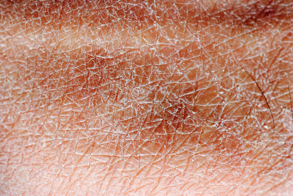 Dry skin texture