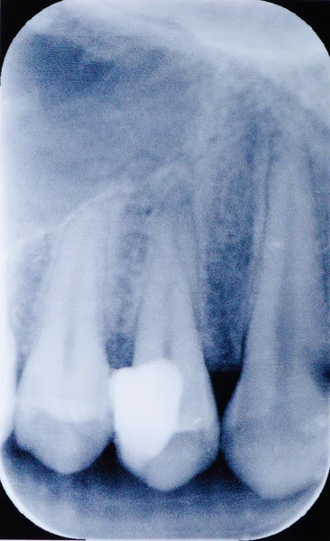 Película de raios-X dentária — Fotografia de Stock