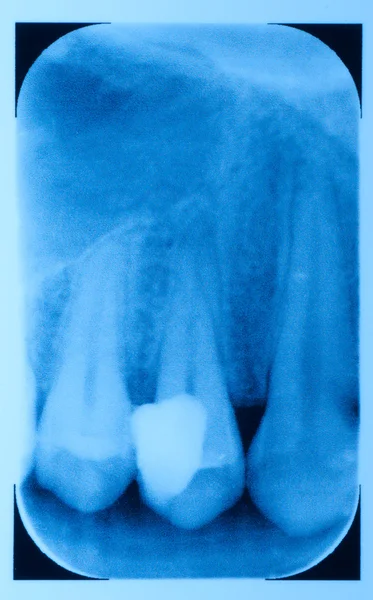 Οδοντιατρική δόντι φιλμ ακτίνων χ — Φωτογραφία Αρχείου