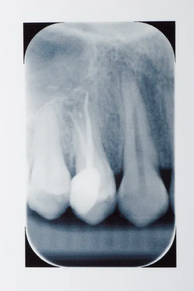 Tooth x-ray film — Stock Photo, Image