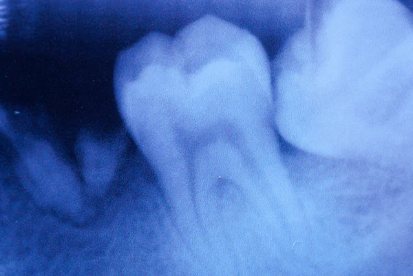 Οδοντιατρική δόντι φιλμ ακτίνων χ — Φωτογραφία Αρχείου