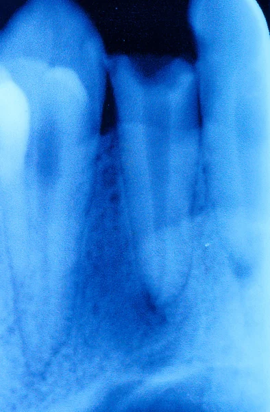 Película de raios-X dentária — Fotografia de Stock