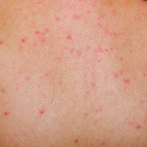 Erupção cutânea alérgica dermatite cutânea — Fotografia de Stock