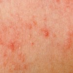 Allergic rash dermatitis skin — Stock Photo © panxunbin #6926399