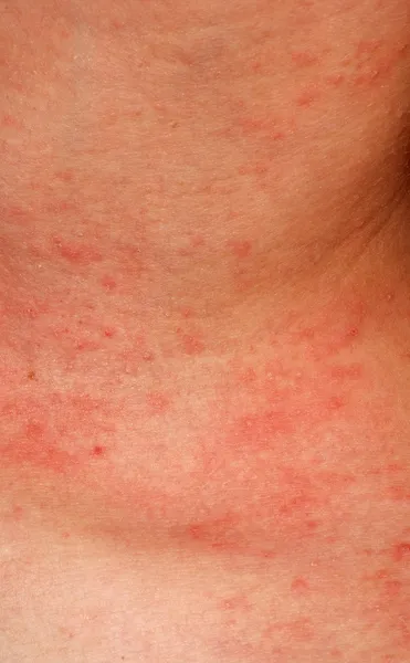 Dermatite cutânea alérgica textura da pele — Fotografia de Stock