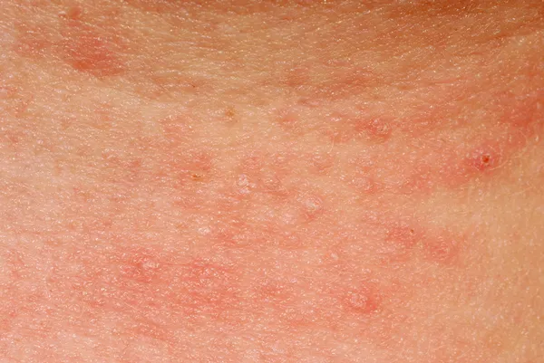 Alergická vyrážka dermatitida kůže textura — Stock fotografie