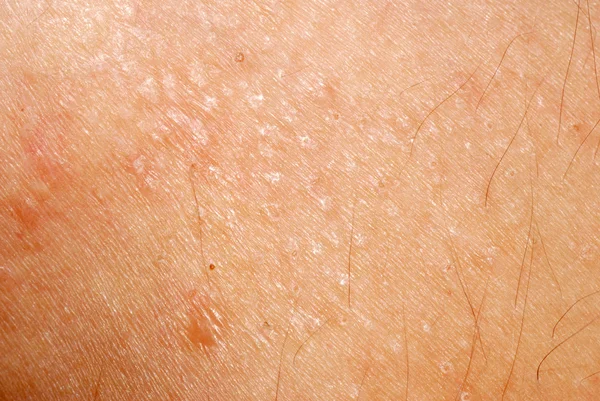 Dermatite éruptive allergique texture de la peau — Photo