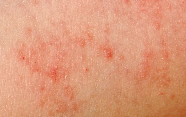 Аллергическая сыпь текстура кожи дерматита — стоковое фото
