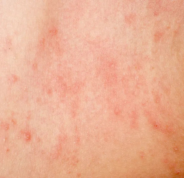 Dermatite cutânea alérgica textura da pele — Fotografia de Stock