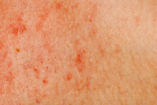 Allergic rash dermatitis skin texture — Stock Photo, Image
