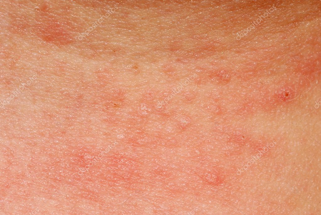 Allergischer Hautausschlag Dermatitis Hautstruktur Stockfotografie