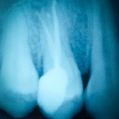 Tooth x-ray film clipart