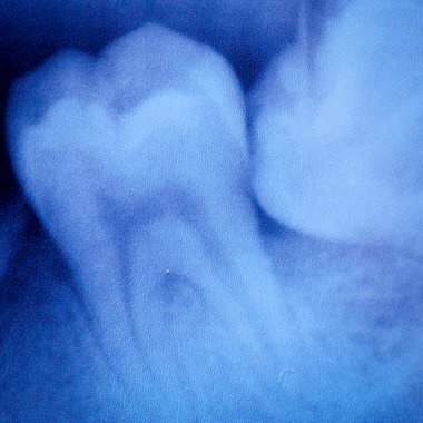 Dental tooth x-ray film clipart