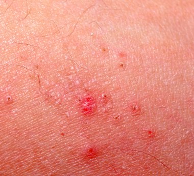Allergic rash dermatitis skin