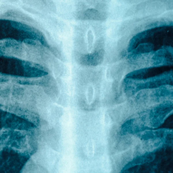Røntgenbillede af brystet - Stock-foto