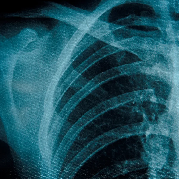 X-ray of chest — Stock Photo, Image