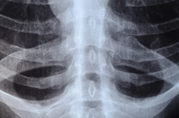 Göğüs röntgeni. — Stok fotoğraf