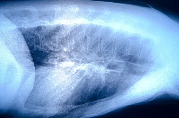 Рентген мышц человека — стоковое фото