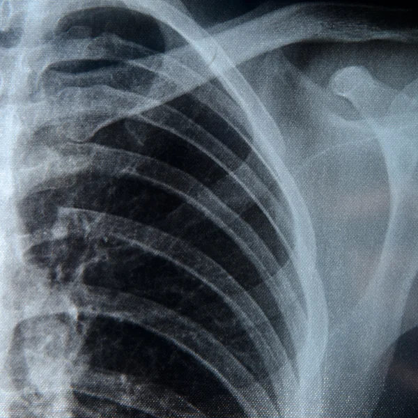 Røntgenbillede af brystet - Stock-foto