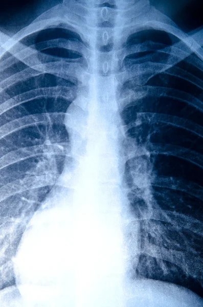 X-ray of chest — Stock Photo, Image