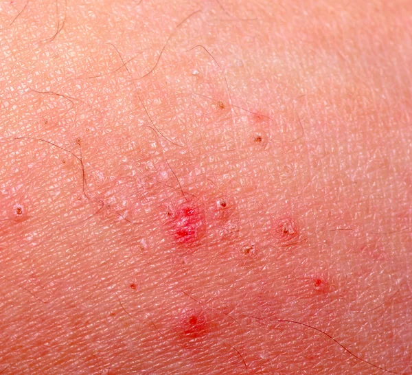 Dermatite cutanée éruption cutanée allergique — Photo