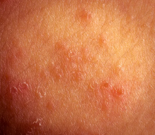 Eccema dermatitis atópica síntomas textura de la piel — Foto de Stock