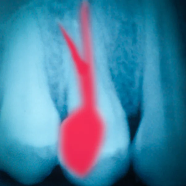 Película de rayos X de dientes —  Fotos de Stock