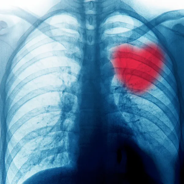 Рентген грудной клетки — стоковое фото