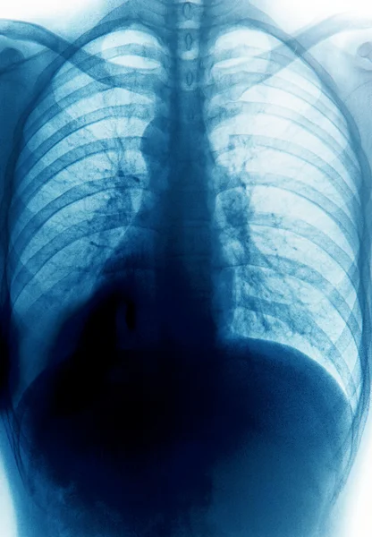 Radiografía de pecho —  Fotos de Stock