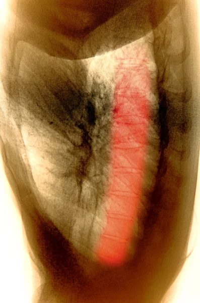 X-ray of human muscle — Stock Photo, Image