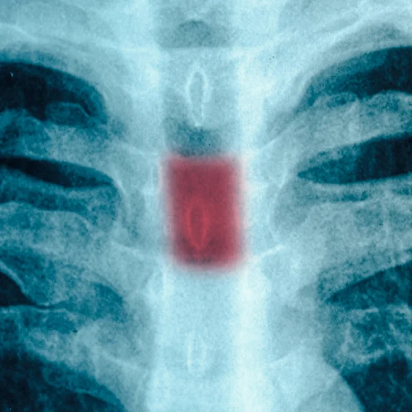 Göğüs röntgeni. — Stok fotoğraf