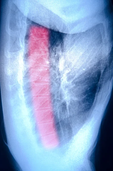 Røntgen af den menneskelige muskel - Stock-foto