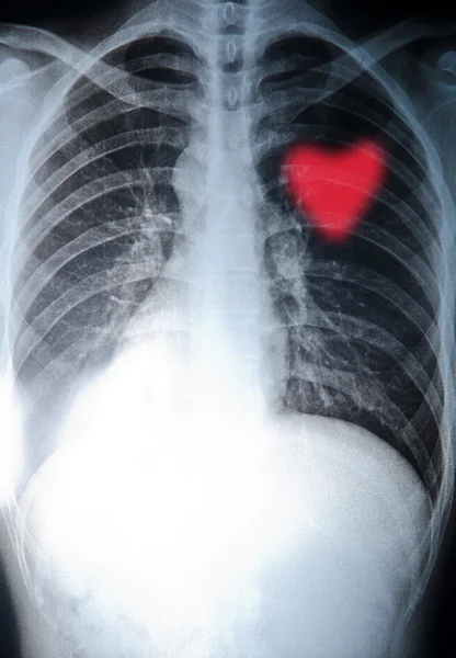 Рентген грудной клетки — стоковое фото