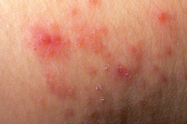 Eccema dermatitis atópica síntomas textura de la piel — Foto de Stock