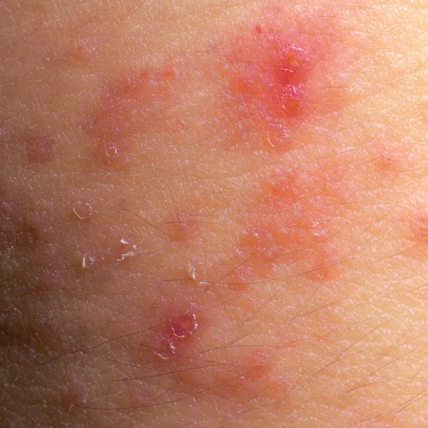 Экзема атопический дерматит симптом текстуры кожи — стоковое фото