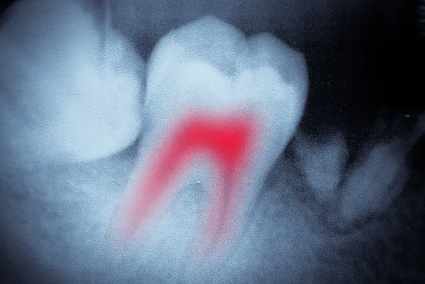 Tandvård tand röntgenfilm Stockbild