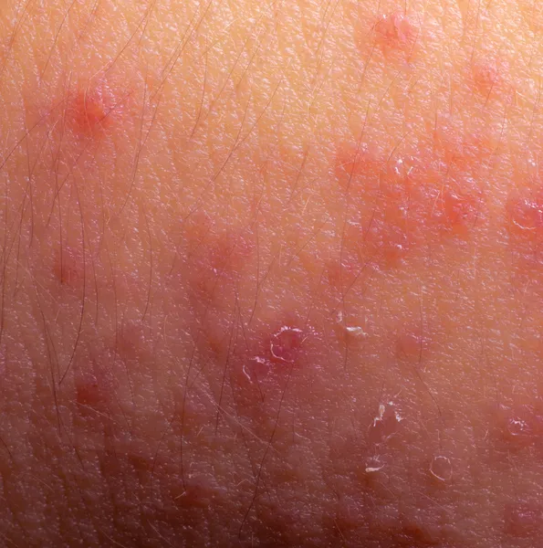 Eczéma dermatite atopique symptôme texture de la peau — Photo