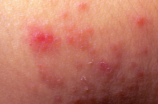 Экзема атопический дерматит симптом текстуры кожи — стоковое фото
