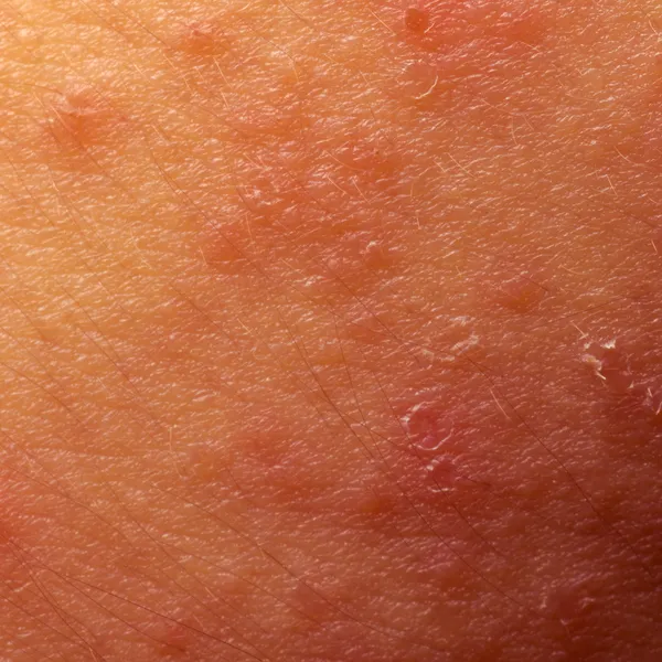 Eczema atopic dermatitis symptom skin texture — Stock Photo © panxunbin ...