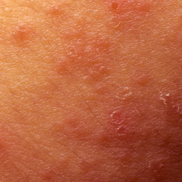 Eczeem atopische dermatitis symptoom huidtextuur — Stockfoto